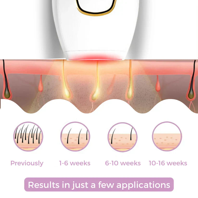 إزالة الشعر بالليزر IPL