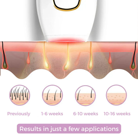 إزالة الشعر بالليزر IPL
